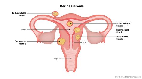 Uterine Fibroid (Myoma) - Causes and Symptoms | Parkway East Hospital