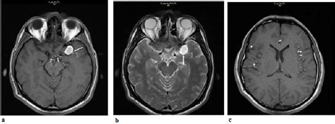 A: Axial T1-weighted MRI image (without gadolinium): In the Sylvian ...