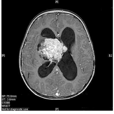 Gadolinium-enhanced MRI (T1 weighted sequence) of a 2year-old girl with... | Download Scientific ...