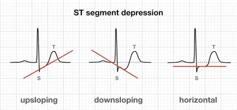 Gambaran Abnormal dan Perubahan Morfologi Pada Gelombang EKG | Portal ...