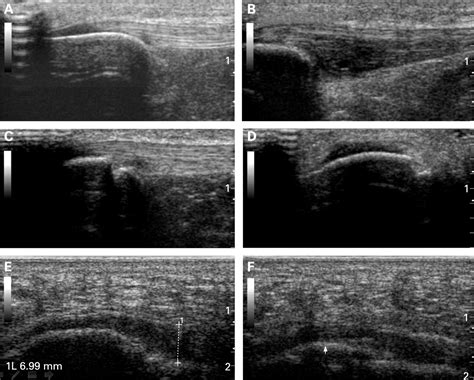 Validity of enthesis ultrasound assessment in spondyloarthropathy | Annals of the Rheumatic Diseases