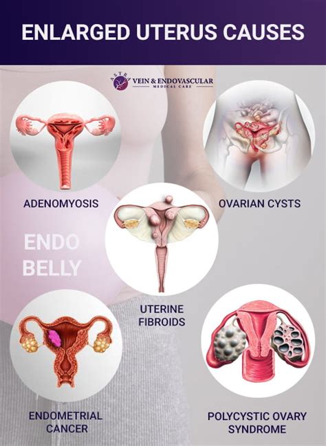 Boggy Uterus: What Is It, Causes, Treatment, And More, 43% OFF