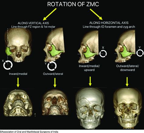 Zygomatic Complex Fracture