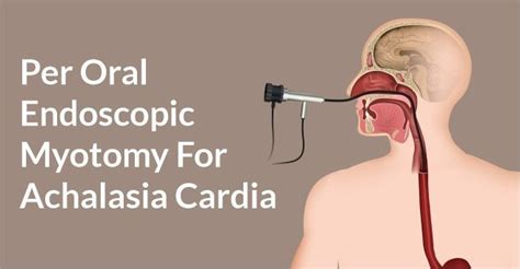 Peroral Endoscopic Myotomy for Achalasia Cardia - Dr. Vatsal Mehta