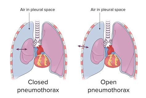 Pneumotórax | Concise Medical Knowledge