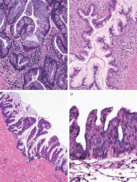 Low-grade appendiceal mucinous neoplasms showed enlarged,... | Download ...