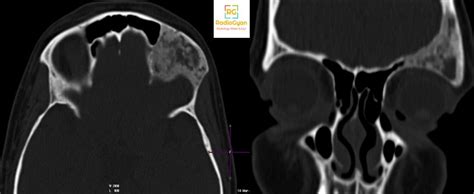 Fibrous Dysplasia Skull Bone Scan