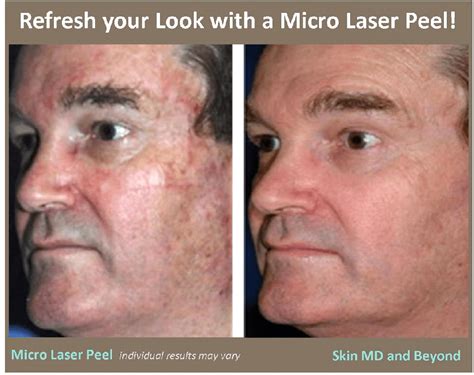 Micro Laser Peel in Plano, TX | Skin MD & Beyond