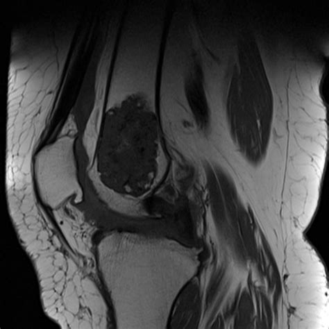 Enchondroma - distal femur | Image | Radiopaedia.org