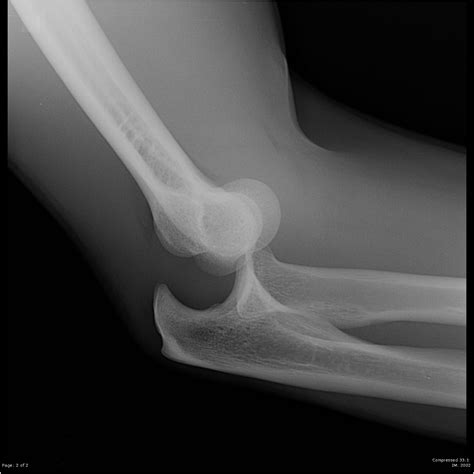 Posterior elbow dislocation | Image | Radiopaedia.org