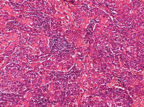 Histological section of the resected thymic carcinoma. Tumor presents... | Download Scientific ...