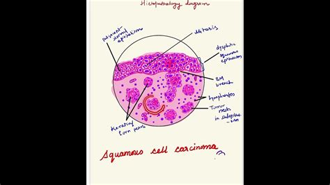 Squamous Cell Carcinoma