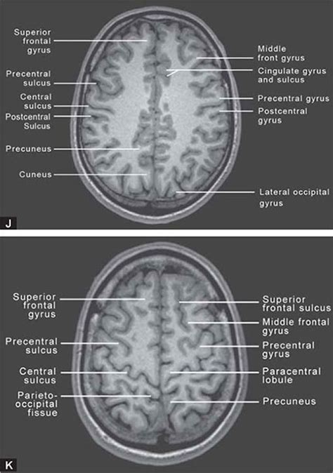 Paracentral Lobule Mri