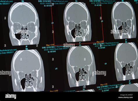 CT scan of male with sinus infection (sinusitis) filling the left ...