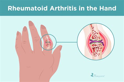 Rheumatoid Arthritis in the Hands: Symptoms and Treatments