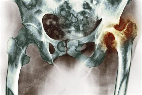 'Osteoarthritis of the hip joint, X-ray' - Stock Image - C002/6998 ...