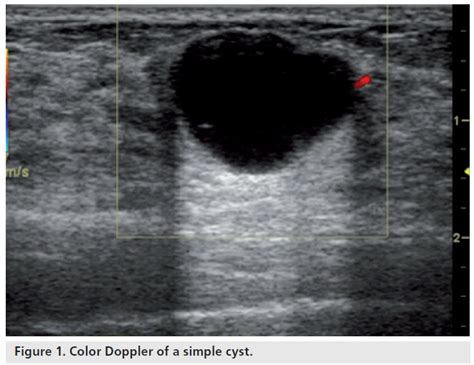 Breast Cyst Ultrasound