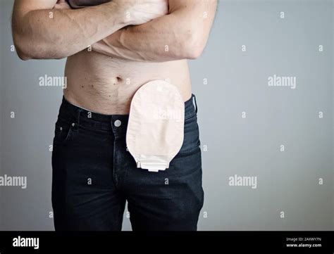 Front view on colostomy bag attached to man patient, medical theme ...