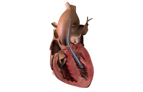 Abiomed touts results of U.S. study of its latest Impella heart pump - MassDevice