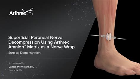 Arthrex - Superficial Peroneal Nerve Decompression Using Arthrex Amnion™ Matrix as a Nerve Wrap