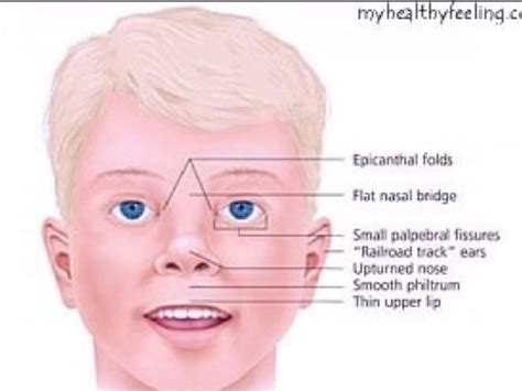 A Description Of Prader Willi Syndrome