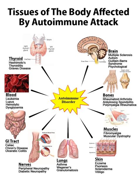 Autoimmune Disease Symptoms - Health Over 70