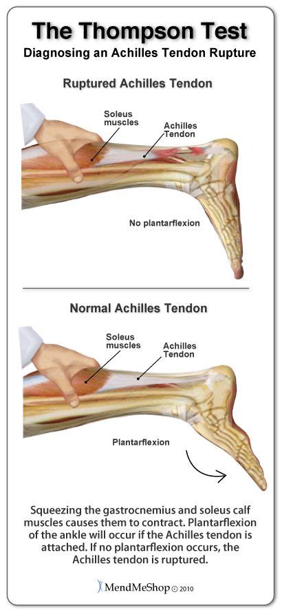 Achilles Tendon Injury Diagnosis | Medical anatomy, Physical therapy ...