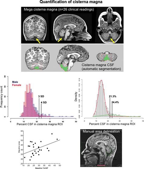 Top 3 images: An example of mega cisterna magna. Second row of 3... | Download Scientific Diagram