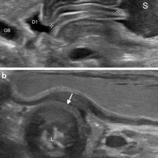 Longitudinal view of the pylorus on ultrasound used to categorize the... | Download Scientific ...