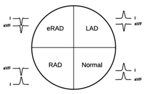 ECG axis - WikEM