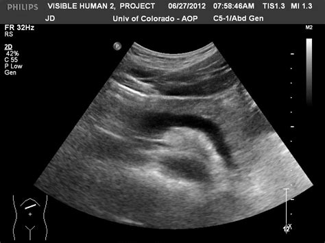 Pancreas Ultrasound