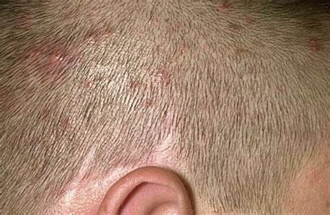 👉 Itchy Bumps on Scalp - Treatment, Pictures, Symptoms, Causes (February 2022)