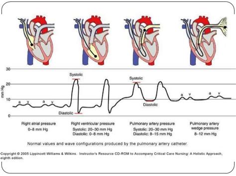 pulmonary artery catheter waveforms - Google Search | Med | Pinterest ...