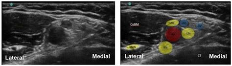 Ultrasound Guided Axillary Brachial Plexus Block : WFSA - Resources