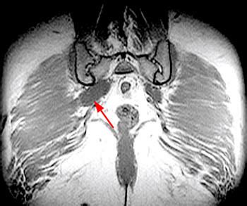 Piriformis Syndrome | Radsource