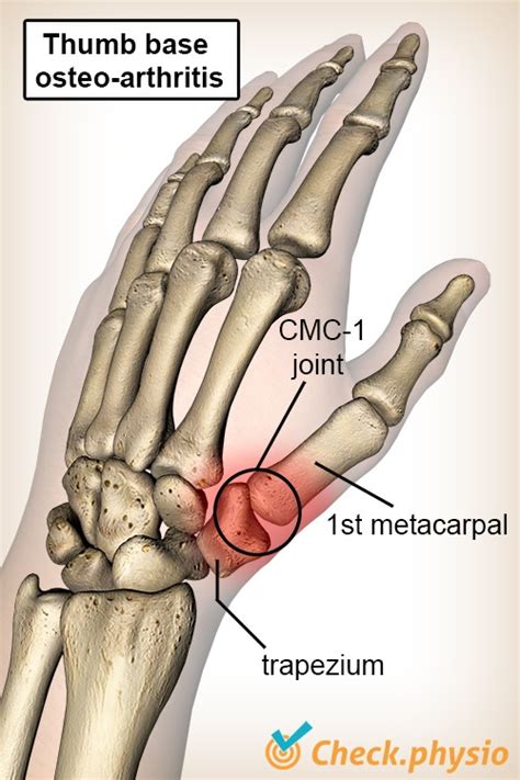 Base of thumb arthritis | Physio Check