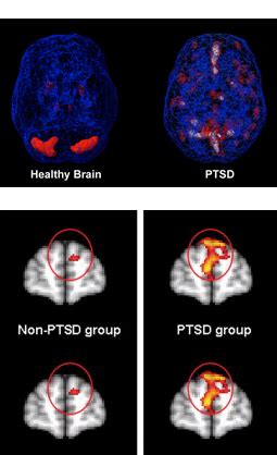 PTSD – Mind Spect