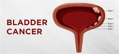 Bladder Cancer- Causes, Symptoms & Treatment - AH