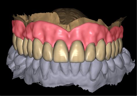 Digital Dentures: Transition of the workflow – GoDigital Dental