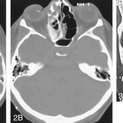 Axial cranial CT scan (A) shows the ethmoid bone lesion with a mixture... | Download Scientific ...