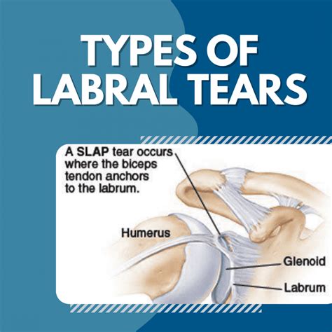 Types of Labral Tears: Ashvin K. Dewan, MD: Orthopedic Surgeon