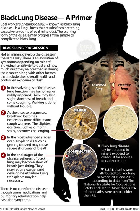 It Took This Coal Miner 14 Years to Secure Black Lung Benefits. How ...