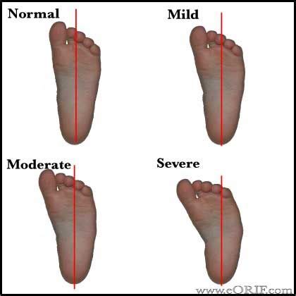 Metatarsus Adductus | Pediatric therapy, Pediatrics, Orthopedics