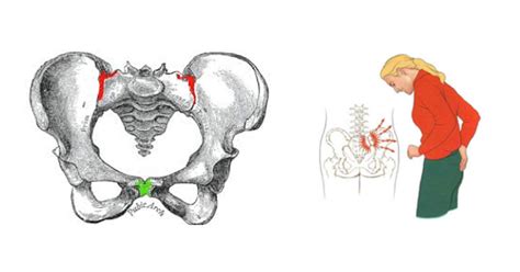 Pelvic Girdle Pain – the sacroiliac joint