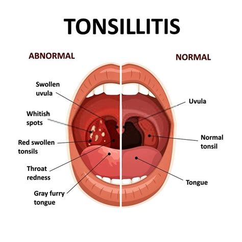 Remedies for Strep throat in 2020 | Strep throat remedies, Respiratory ...