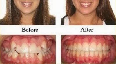 All You Need to Know About Headgear Braces – MedRition