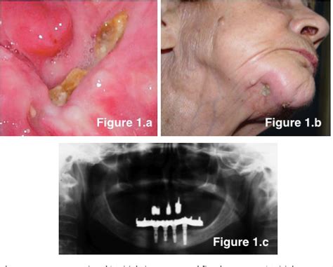 Figure 1 from Jaw osteonecrosis after dental implants associated with ...