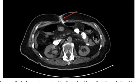 Figure 1 from Complications of a Percutaneous Endoscopic Gastrostomy ...