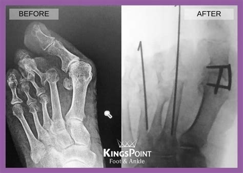 First Metatarsal-phalangeal Joint (MTP) Arthrodesis | Foot and Ankle ...