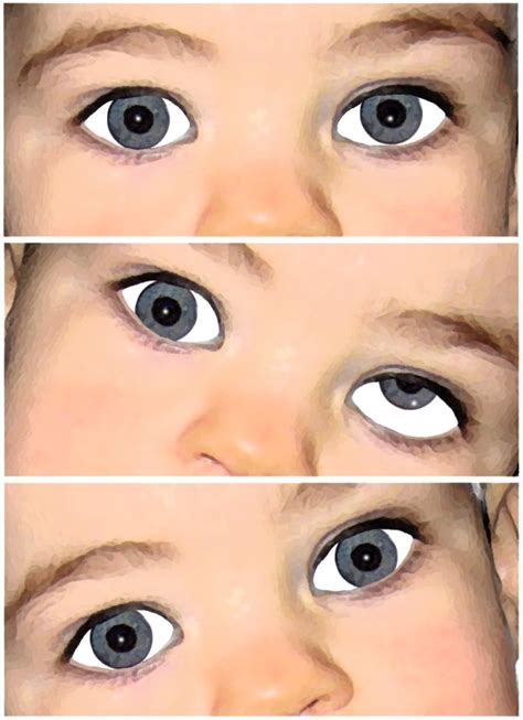 Congenital paralysis of the superior oblique - A child's eyes - Athens Eye Hospital